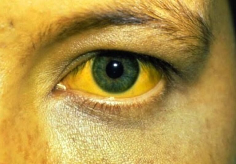 Que pasa si uno se ve amarillo ?, conozca la bilirrubina