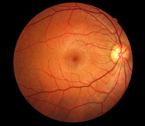 La Enfermedad de la Retina por causa de la Diabetes, como prevenirla